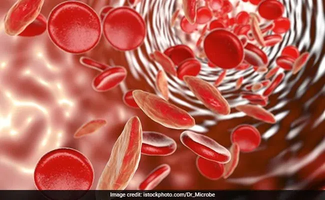 Sickle Cell Anemia