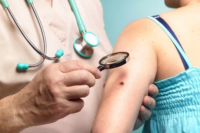 तिल और मस्से का बदले रंग तो हो सकता है कैंसर