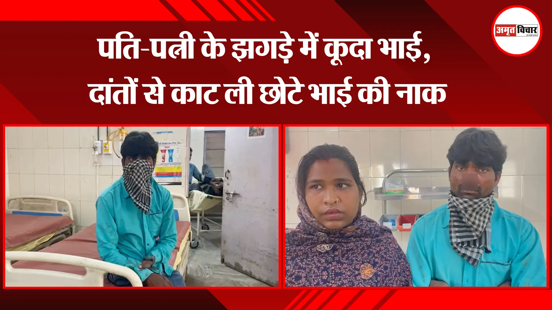 बरेली: पति-पत्नी के झगड़े में कूदा भाई, दांतों से काट ली छोटे भाई की नाक 