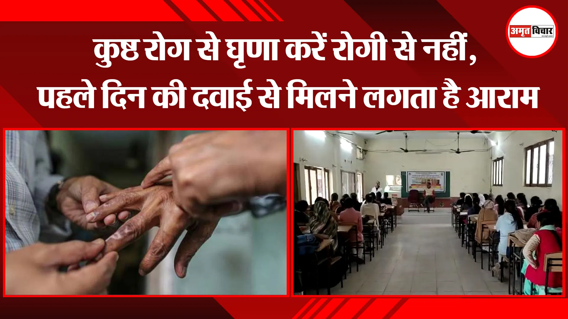 मुरादाबाद: कुष्ठ रोग से घृणा करें रोगी से नहीं, पहले दिन की दवाई से मिलने लगता है आराम