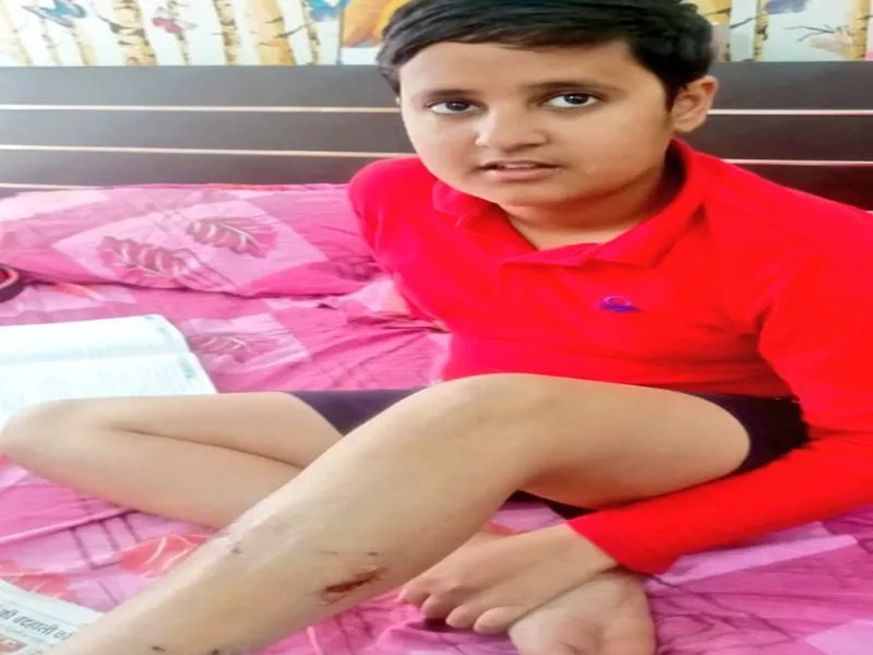 लखनऊ: कुत्तों ने बच्चों पर बोला हमला, एक को काटा 