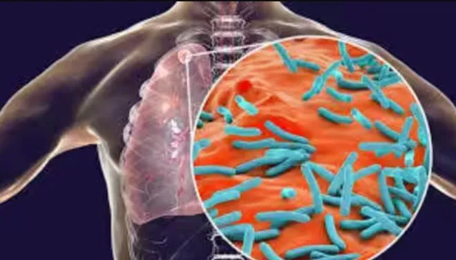 बरेली: 20 से शुरू होगा क्षय रोगियों को खोजने का अभियान
