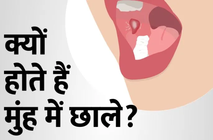 मुंह में छाले क्यों हो जाते हैं? जानें वजह...