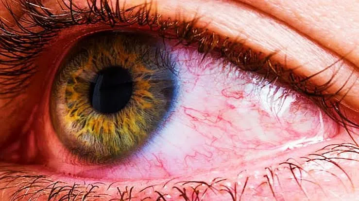 पीलीभीत: साहब, बचपन से ही खराब है युवक की आंख...कराइए तो जांच