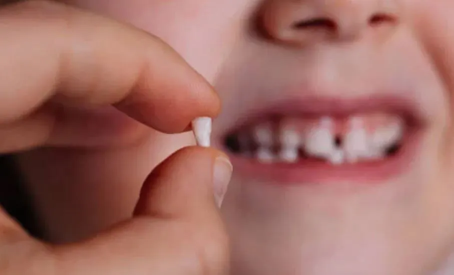 बच्चे के दूध के दांत सड़ रहे हैं तो कराएं इलाज, टूटने का न करें इंतजार