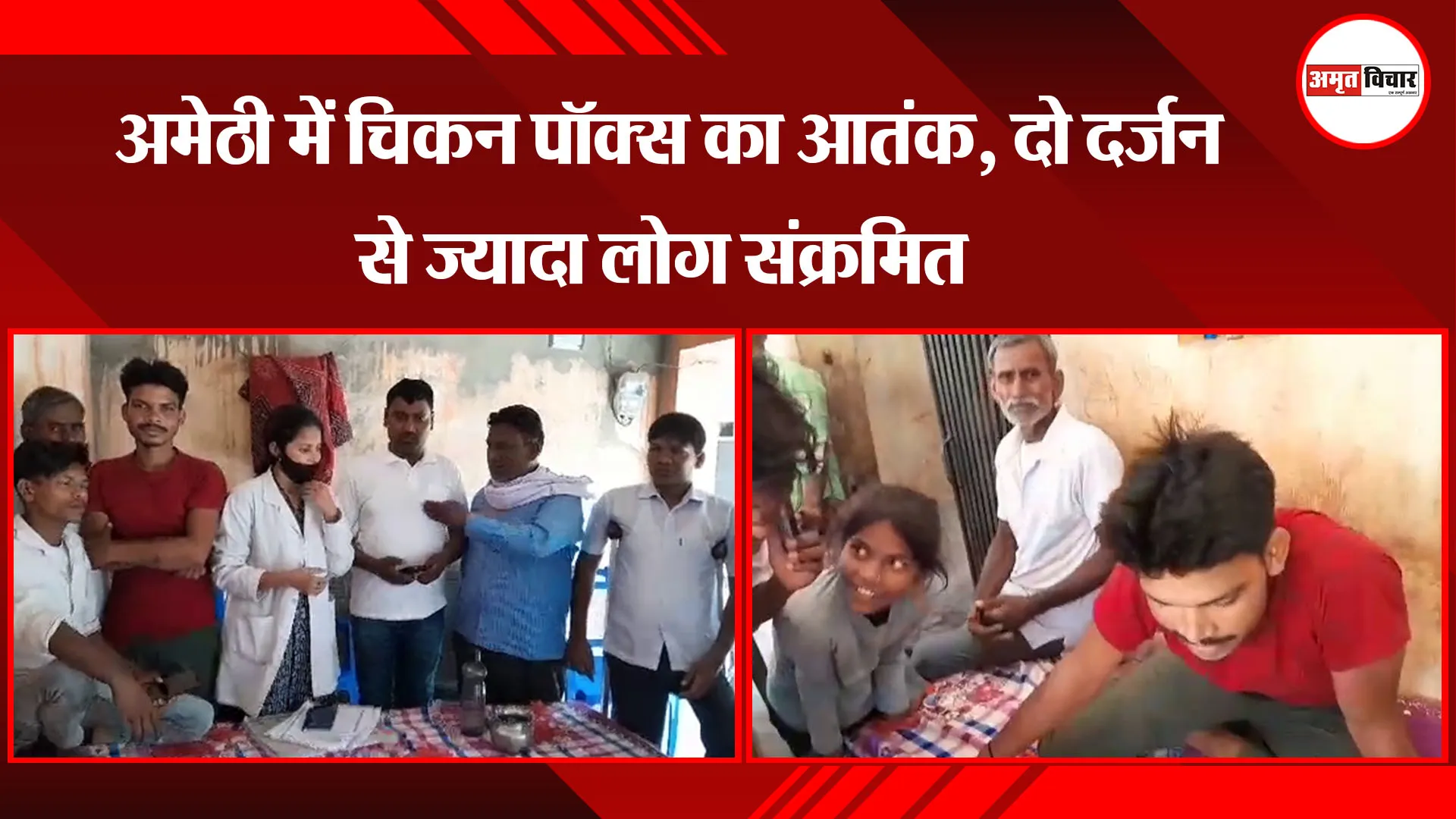 अमेठी में चिकन पॉक्स का आतंक, दो दर्जन से ज्यादा लोग संक्रमित