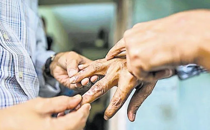 कुष्ठ रोगियों के लिए खुशखबरी, हाईकोर्ट की सख्ती के बाद फंड हुआ जारी