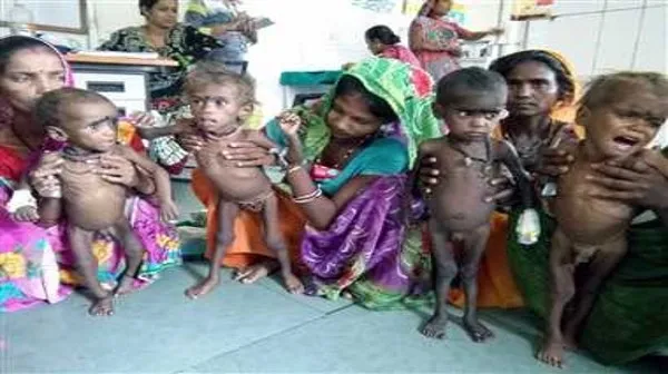 मध्यप्रदेश: जनवरी से मार्च तक 78 हजार से अधिक बच्चे कुपोषित, पहले तीन महीने का आंकड़े