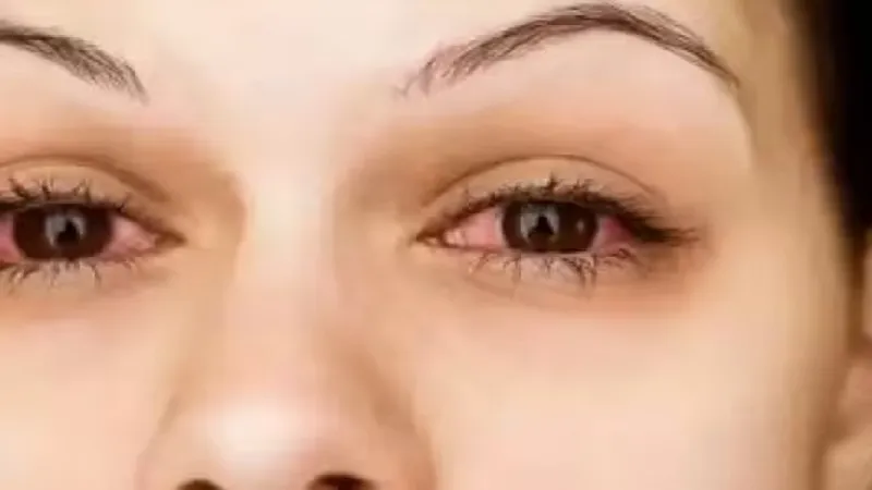 संभल: आश्रम पद्धति विद्यालय के 43 छात्रों की आंखों में संक्रमण