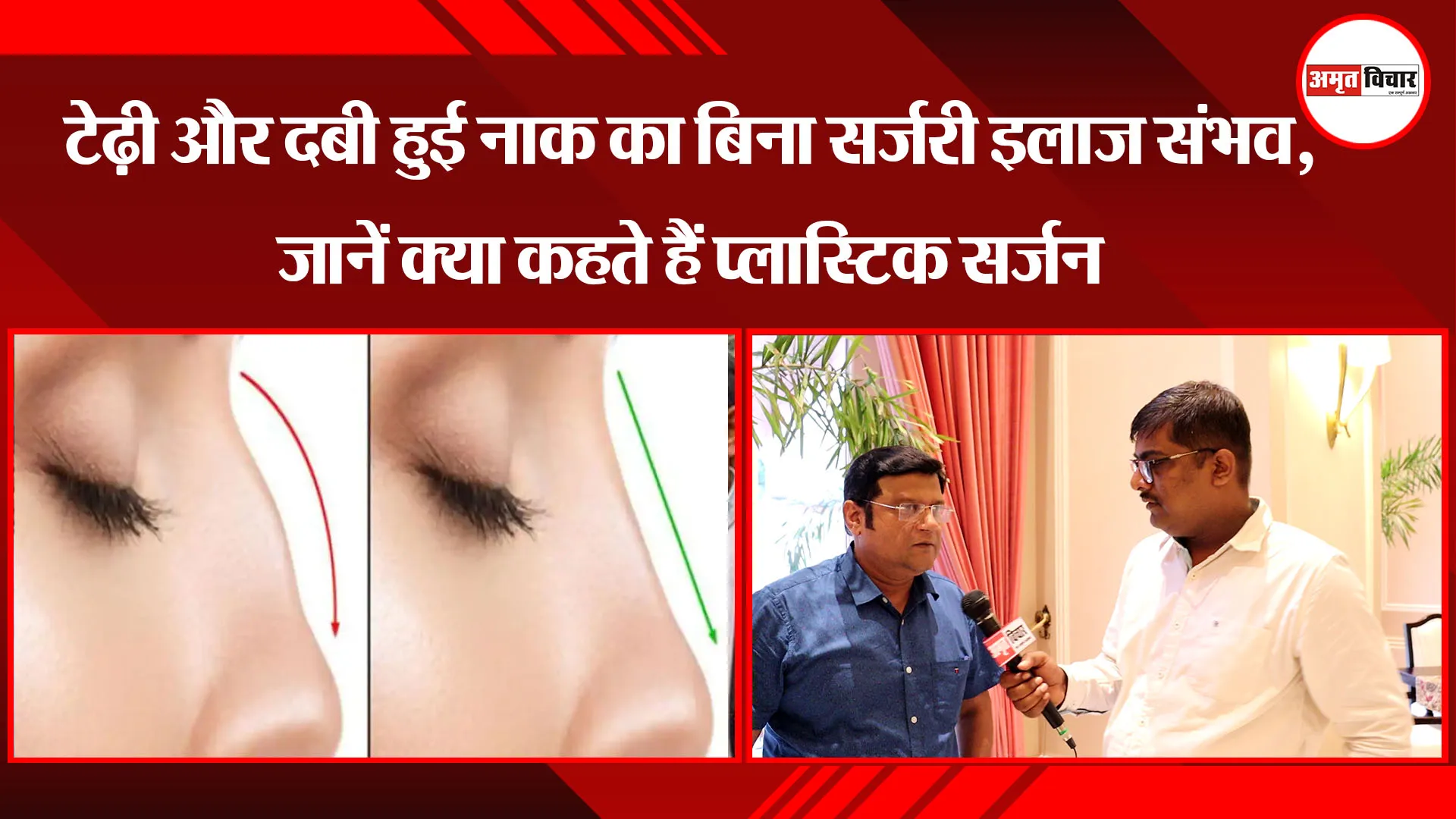 लखनऊ: टेढ़ी और दबी हुई नाक का बिना सर्जरी इलाज संभव, जानें क्या कहते हैं प्लास्टिक सर्जन