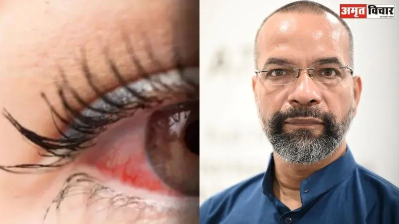सावधान : आंखों में तेजी से बढ़ रहा संक्रमण, बच्चे और शुगर पीड़ित मरीज रहें सावधान, हो सकती है गंभीर बीमारी