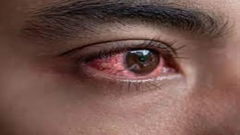 अमेठी: ओपीडी में आ रहे 70 फीसदी आई फ्लू के मरीज, डॉक्टरों ने दी ये सलाह