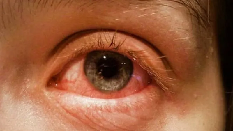 Conjunctivitis Eye Flu: बच्चों में फैल रहे आई फ्लू ने अभिभावकों की बढ़ाई टेंशन, चश्मा लगाकर स्कूल जा रहे छात्र-छात्राएं