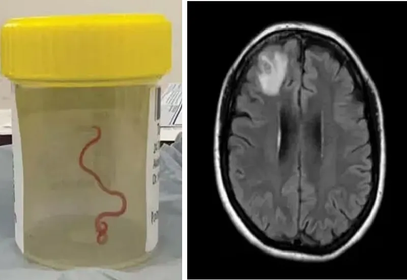 OMG! महिला के दिमाग में मिला 'जिंदा' रेंगता हुआ कीड़ा, इलाज कर रहे डॉक्टर भी हुए हैरान