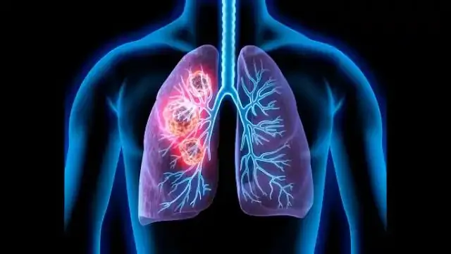 मानव शरीर में इस कारण तेजी से फैलता है कैंसर? जानें क्या कहता है अध्ययन