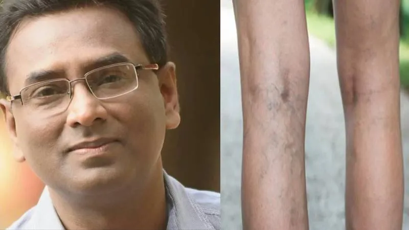 National Vascular Day: पैरों में सूजन से हैं परेशान तो तंबाकू से हो जायें सावधान