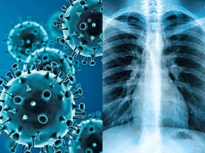 सीने के एक्स-रे से उम्र बताने वाला AI-मॉडल विकसित, गंभीर बीमारियों का लगा सकता है पता 