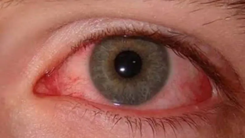 कंजक्टिवाइटिस : तेजी से फैल रही आंखों की बीमारी, बचने का आसान तरीका बता रहे चिकित्सक