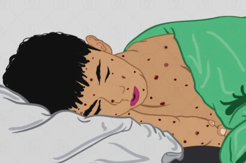 Bareilly: शहर में चिकन पॉक्स की दस्तक, युवक मिला ग्रसित