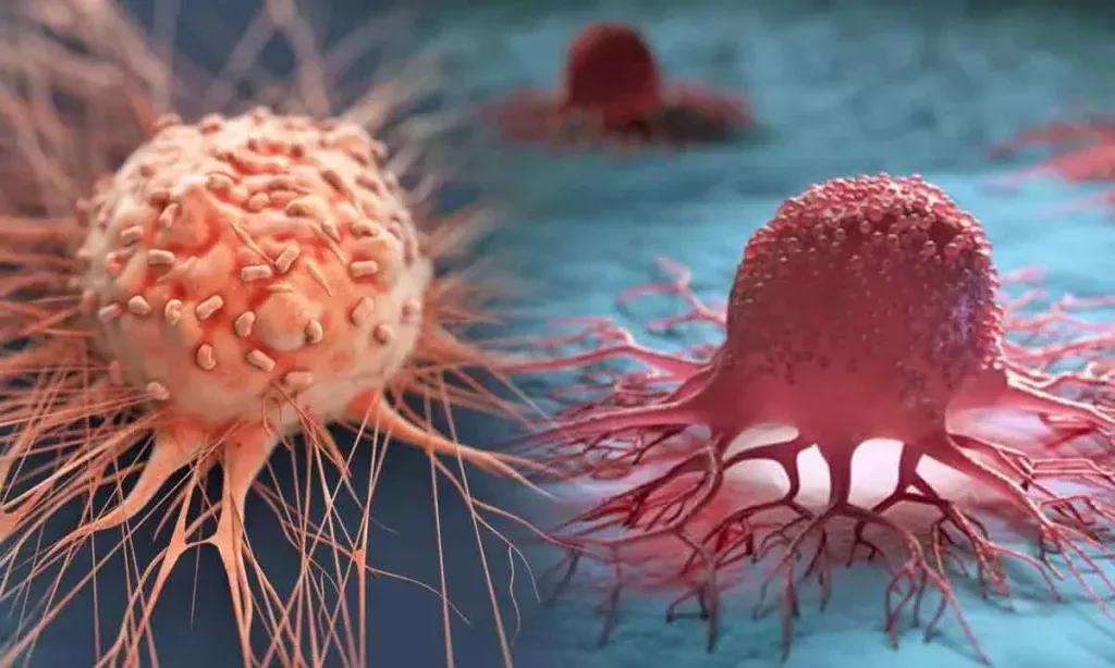 50 साल से कम उम्र में बढ़ रहे हैं कैंसर के मामले, लेकिन कारण अज्ञात 