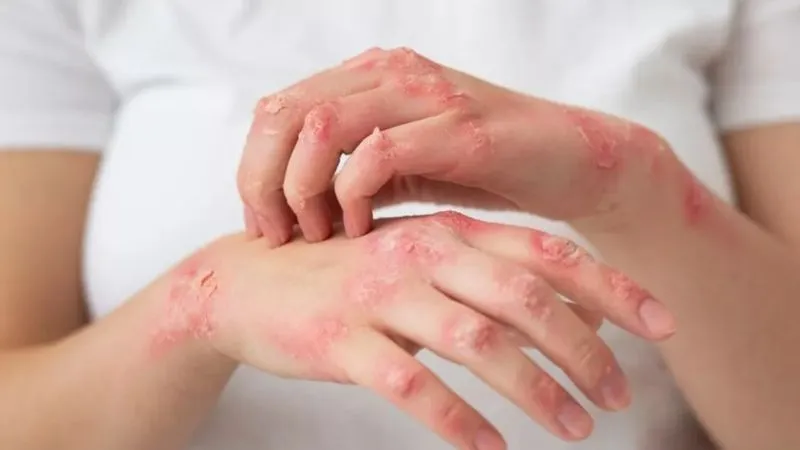 Kanpur News: 14 दिन में मिले 1379 संभावित कुष्ठ के मरीज, लक्षण दिखने पर तत्काल डॉक्टर से करें संपर्क