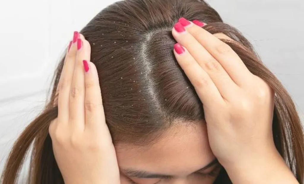 डैंड्रफ की समस्या से हैं परेशान, इन घरेलू उपायों को अपनाकर दूर करें समस्या 