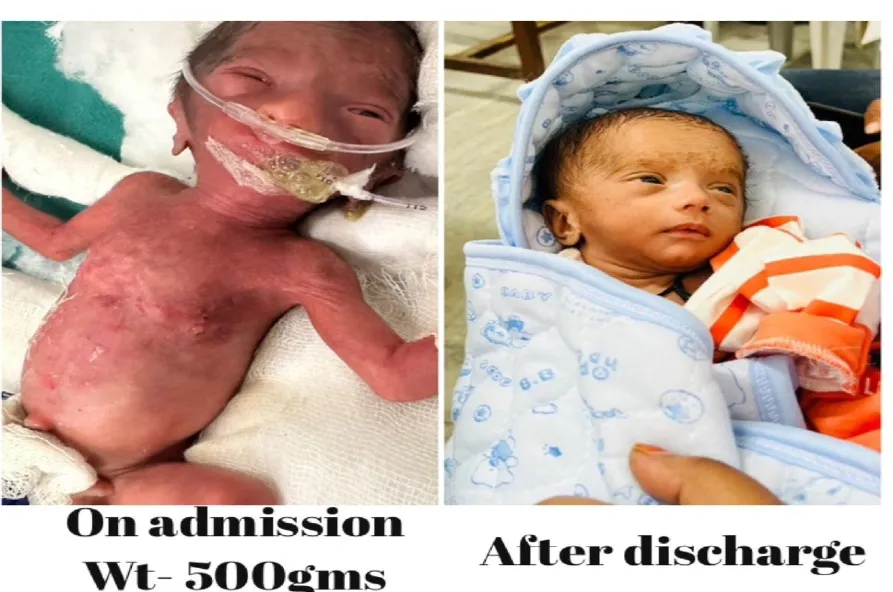 बरेली: 500 ग्राम का था नवजात का वजन, बेहतर इलाज से हुआ स्वस्थ