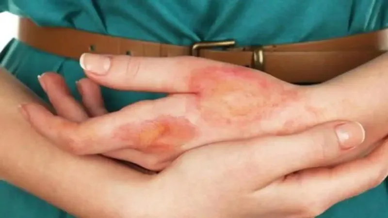 Diwali 2023: पटाखों से जलने पर अपनाएं ये घरेलू नुस्खे, मिलेगी राहत, जल्द भरेंगे घाव