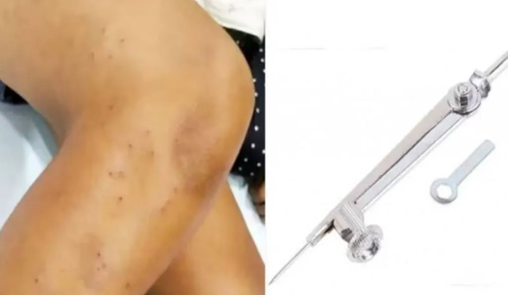 चौथी क्लास के छात्रों के बीच खेल-खेल में लड़ाई, 3 ने मिलकर क्लासमेट को राउंडर से 108 बार गोदा