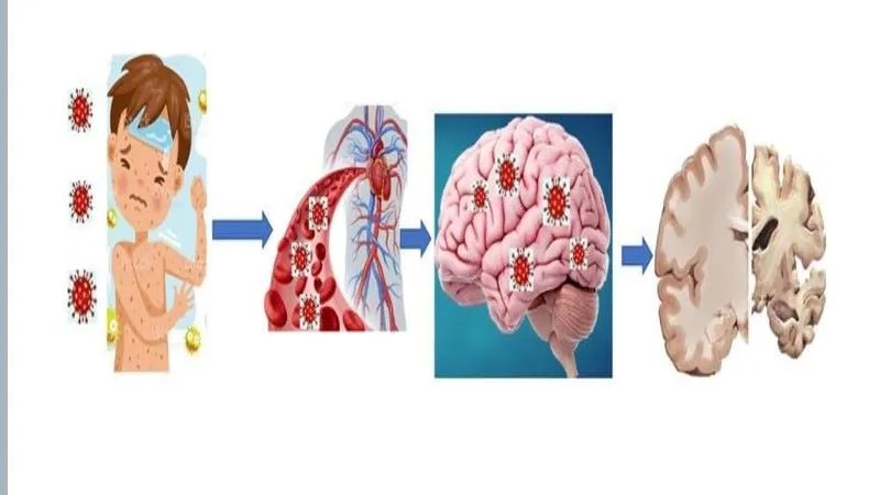 Corona Effect : इस जानलेवा बीमारी की चपेट में आ रहे हैं बच्चे, यूपी में हर साल 20 के करीब पहुंच रहा मौत का आंकड़ा