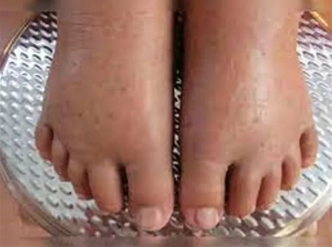 सर्दियों में पैर और पैरों की उंगलियों में हाने वाली सूजन से इस तरह करें बचाव, जानिए उपाय