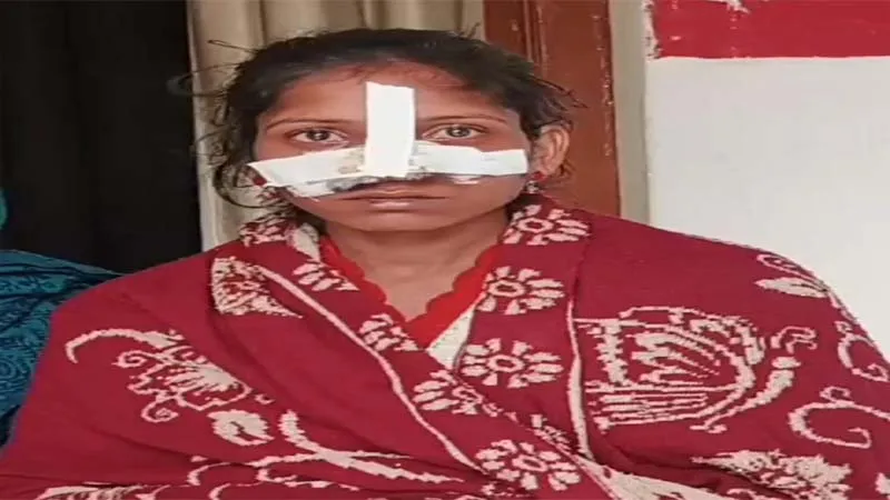 गोंडा: घरेलू विवाद में पति ने दांत से काटी पत्नी की नाक, केस दर्ज