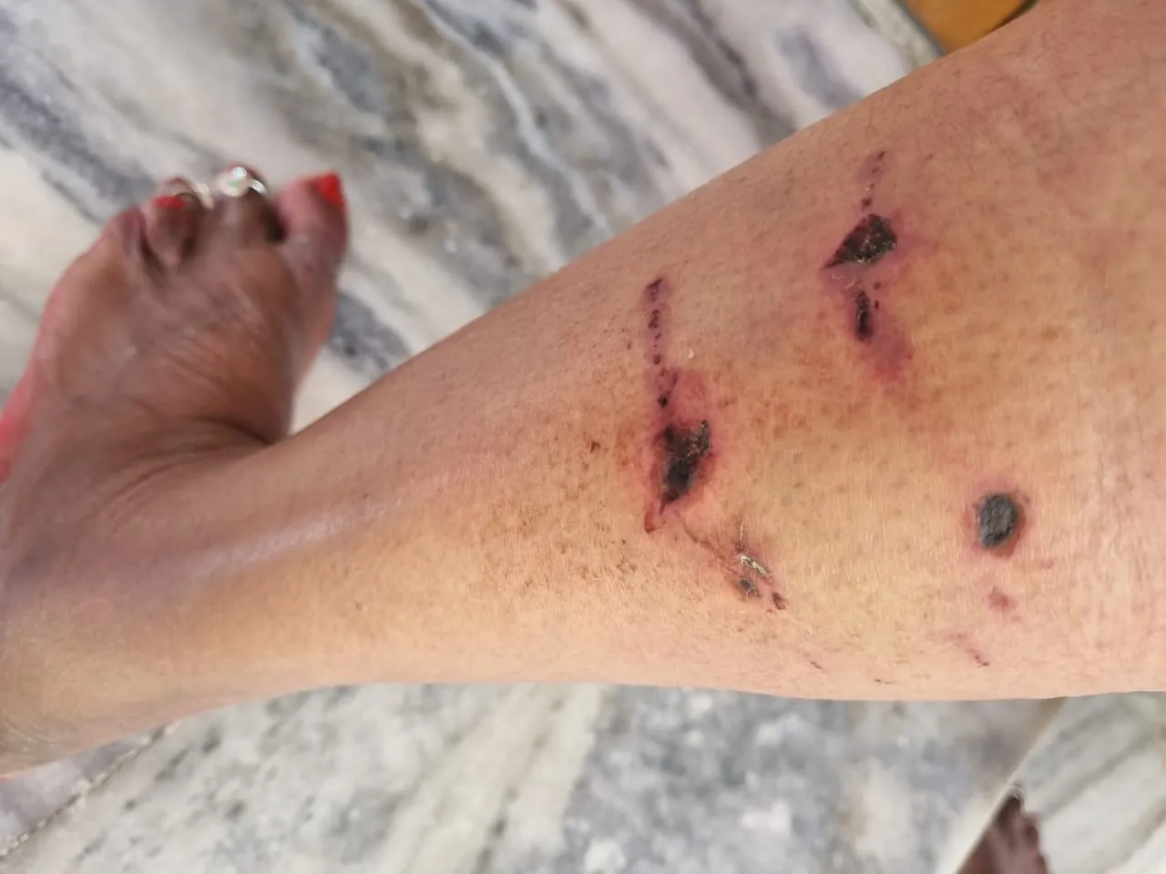 बरेली: सिविल लाइंस में कुत्तों ने महिला को दौड़ाकर काटा, पॉश कालोनी में आतंक से लोग परेशान