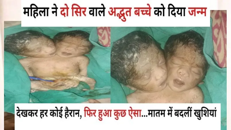 बरेली: महिला ने दो सिर वाले अद्भुत बच्चे को दिया जन्म, देखकर हर कोई हैरान, फिर हुआ कुछ ऐसा...मातम में बदलीं खुशियां 