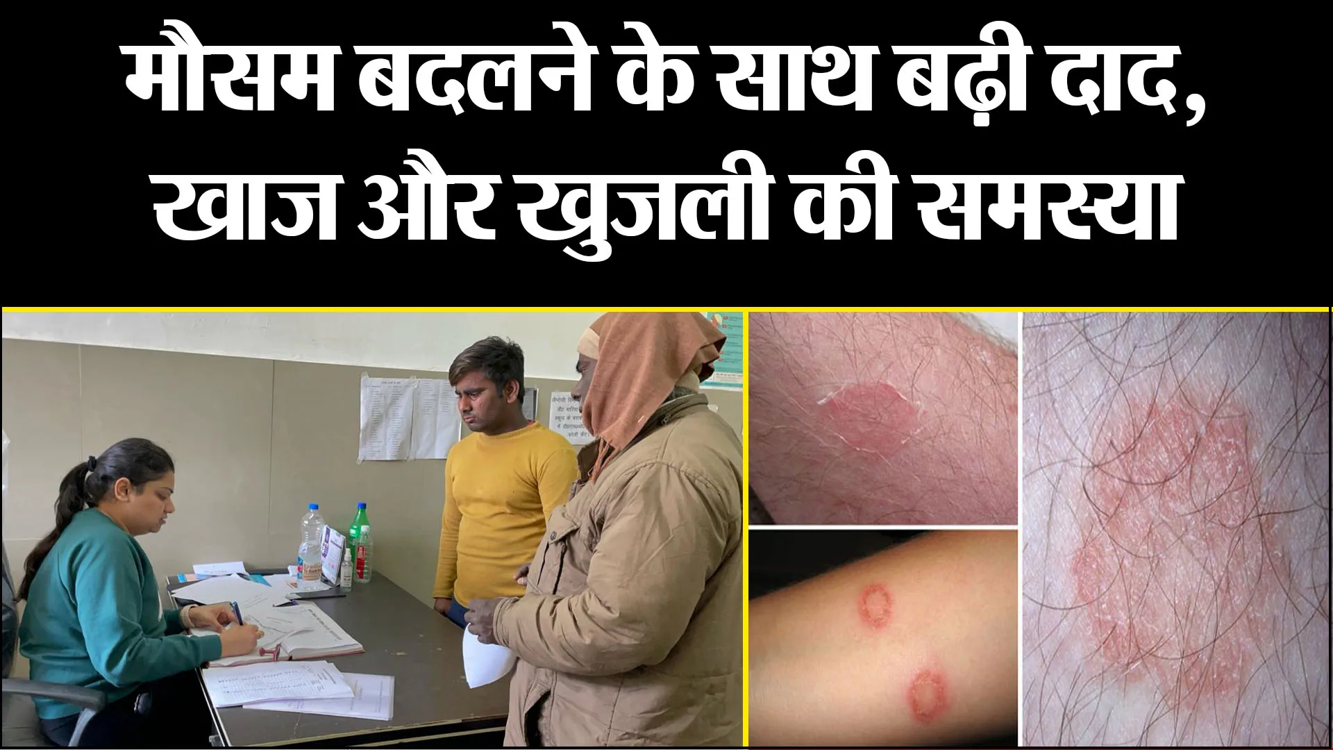 बरेली: मौसम बदलने के साथ बढ़ी दाद, खाज और खुजली की समस्या, जानिए चिकित्सक की राय... 