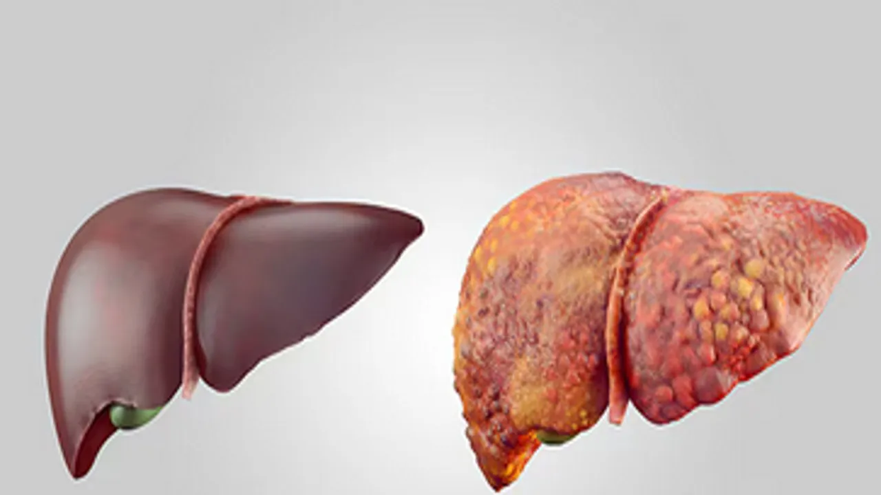 लखनऊ: लिवर सिरोसिस के बढ़ रहे मामले, ग्रामीण इलाकों में ज्यादा मिल रहे मरीज, आयुर्वेद में इलाज संभव