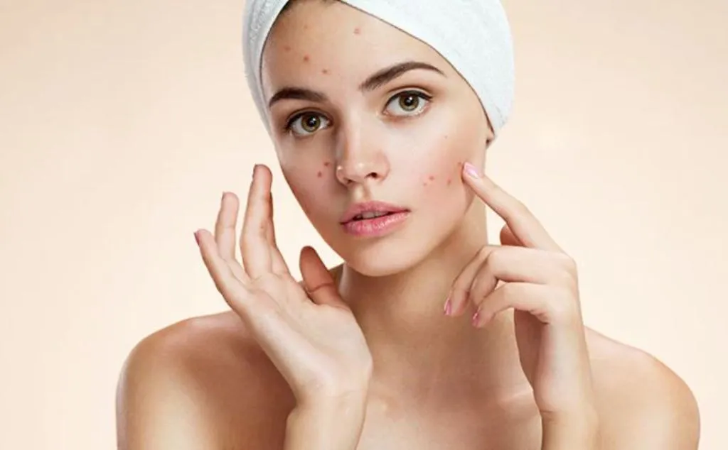 पिंपल्स से हैं परेशान, इन घरेलू फेस पैक्स का करें यूज...दूर होगी समस्या