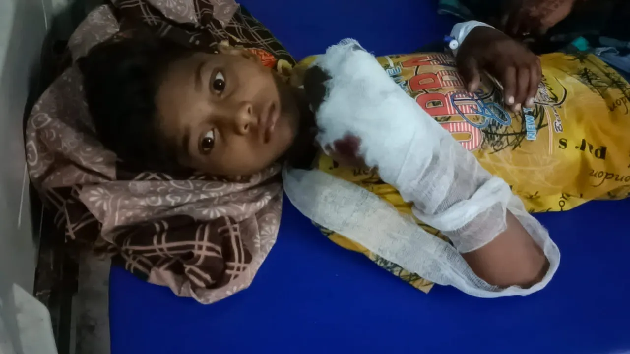 बहराइच में बिना चले पटाखे को दगाने के प्रयास में छात्र झुलसा, हालत में सुधार नहीं  