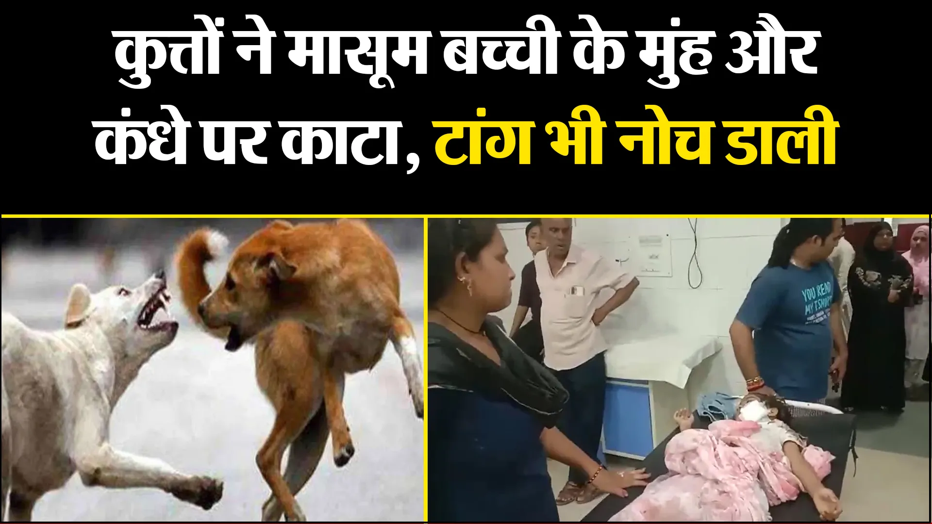 मुरादाबाद: कुत्तों ने मासूम बच्ची के मुंह और कंधे पर काटा, टांग भी नोच डाली