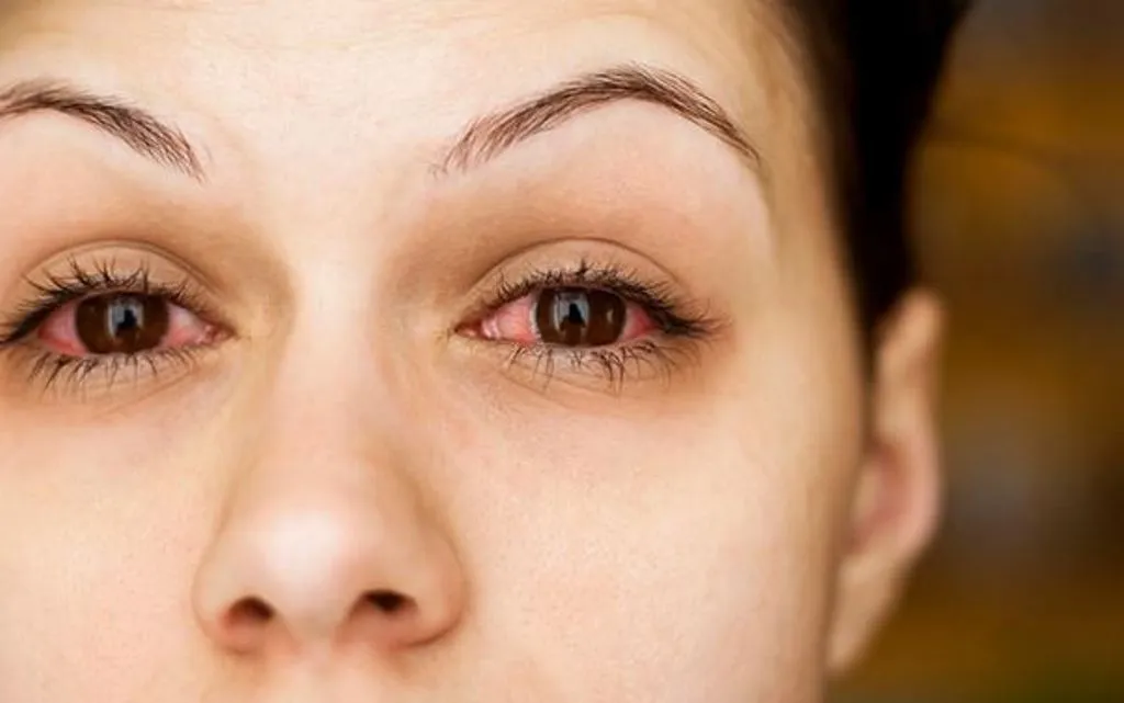 Bareilly News: गर्म हवाओं से आंखों में हो रही जलन, कंजेक्टिवाइटिस के बढ़े मरीज...ऐसे रखें ध्यान