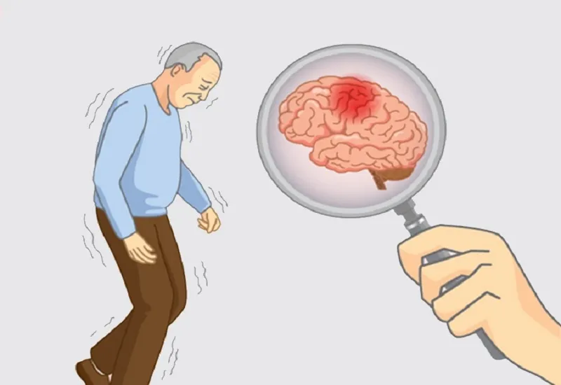 अल्जाइमर को वास्तव में उलटा किया जा सकता है, वृत्तचित्र का दावा 