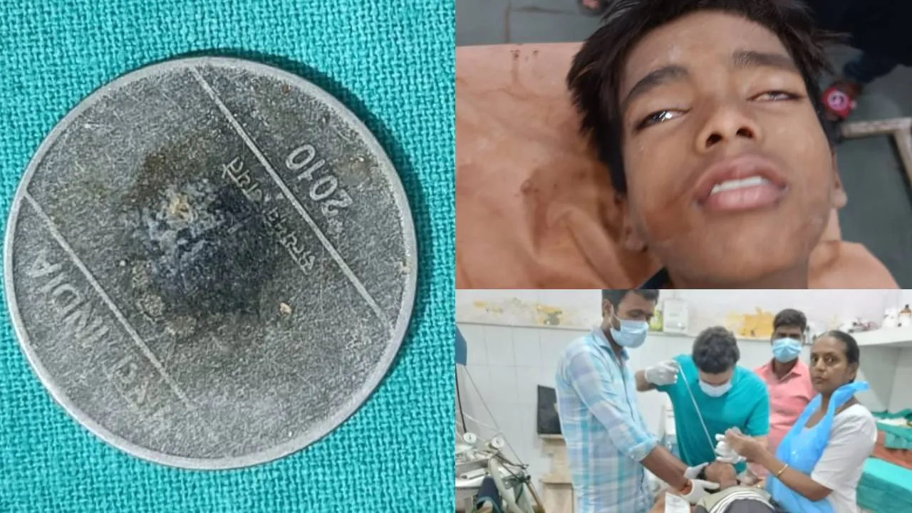 हरदोई के डॉक्टर का कमाल: 7 साल से बच्चे के गले में फँसा था सिक्का, सर्जरी कर निकाला