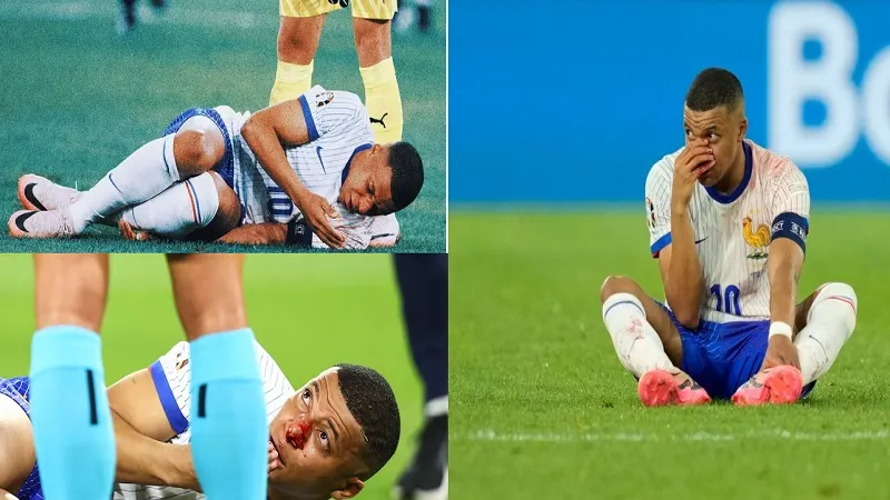 European Football Champions : फ्रांस ने ऑस्ट्रिया को 1-0 से हराया, Kylian Mbappé की नाक में लगी चोट 