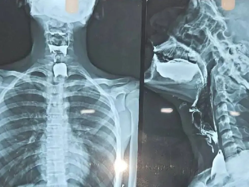 प्रयागराज: व्रत में युवक के लिए आलू बना जानलेवा, 72 घंटे बाद डॉक्टरों ने गले से निकाला
