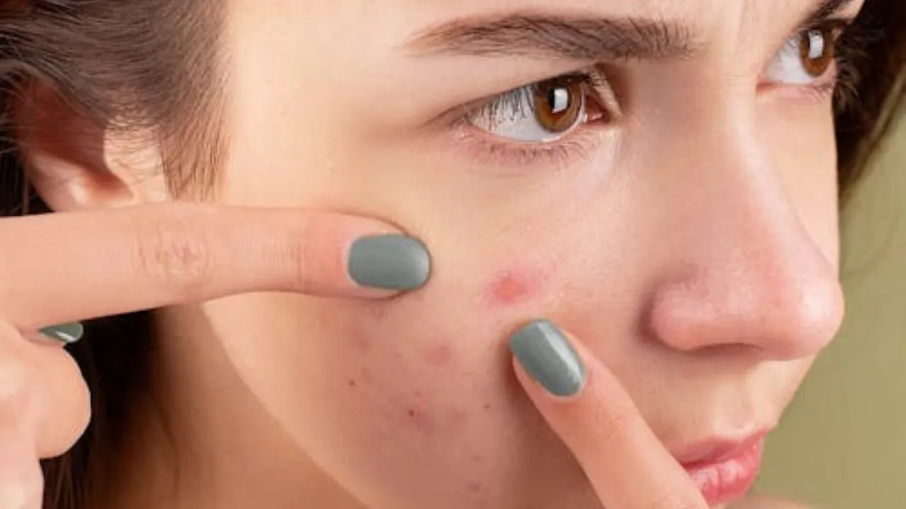 Skincare: बारिश में मुहांसों से परेशान? करें ये टिप्स फॉलो