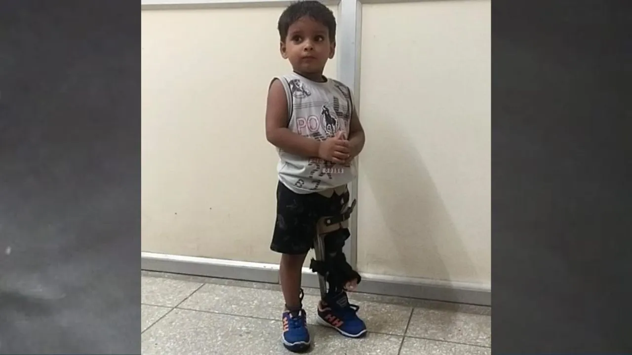 लखनऊ: दिव्यांगता पर ‘अनंत’ की जीत, KGMU के लिंब सेंटर में कृतिम पैर लगाकर उसे दिया चलने का प्रशिक्षण