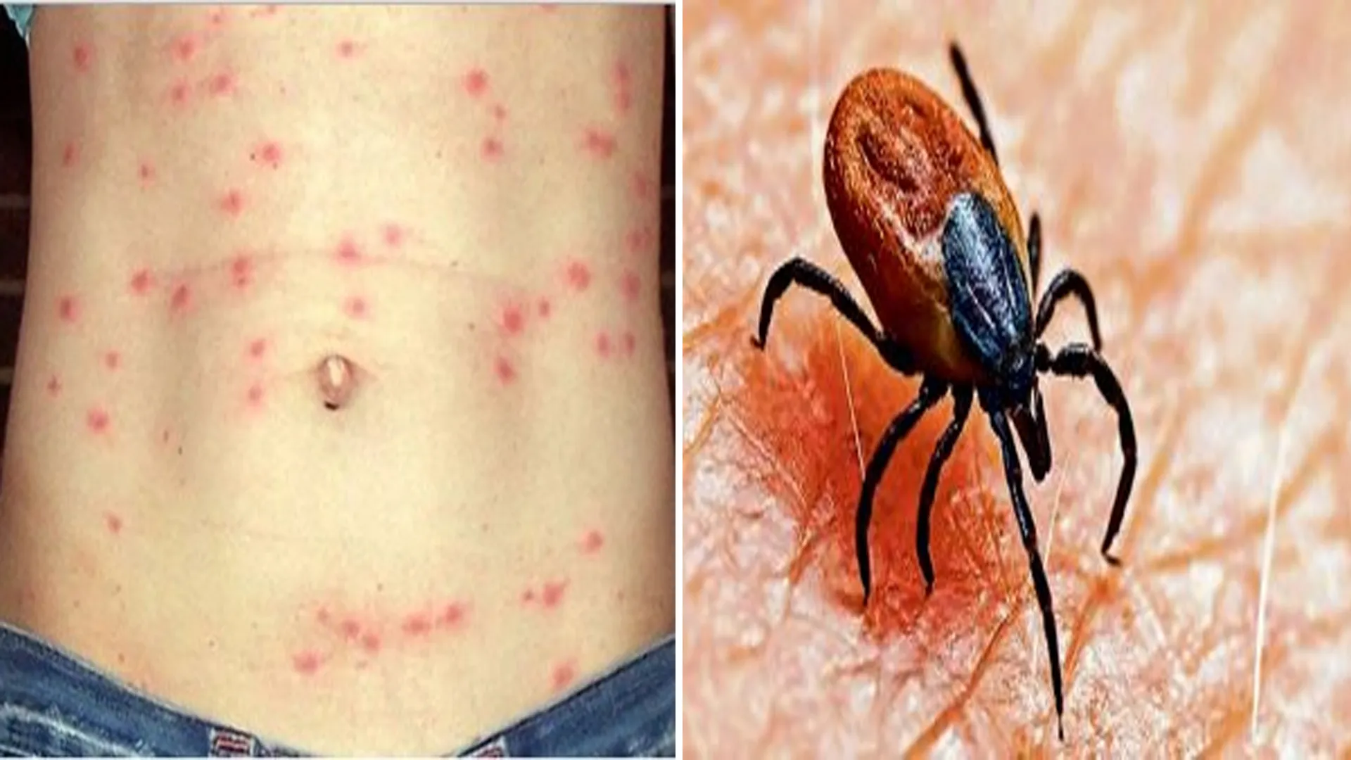 बरेली: स्क्रब टायफस ने बढ़ाई चिंता...दो संदिग्ध मरीज मिलने से खलबली 