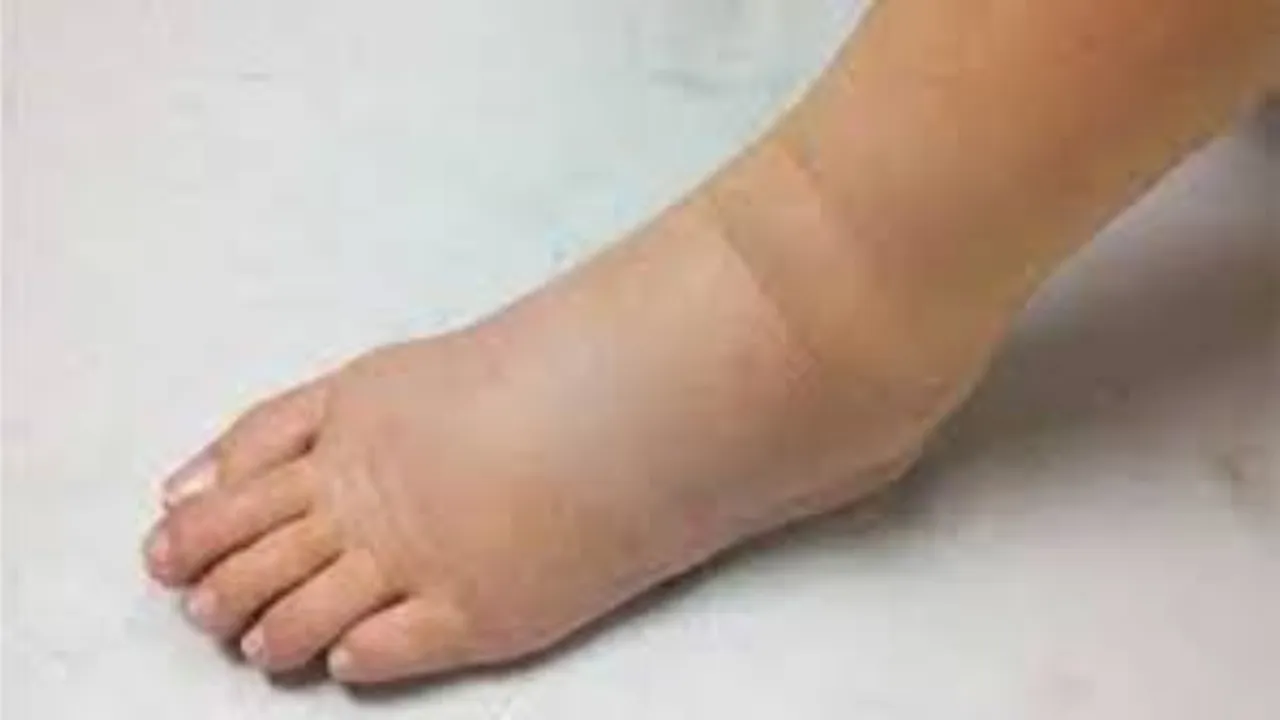 फाइलेरिया से बचाव है जरूरी, 2027 तक फाइलेरिया मुक्त बनाने का लक्ष्य