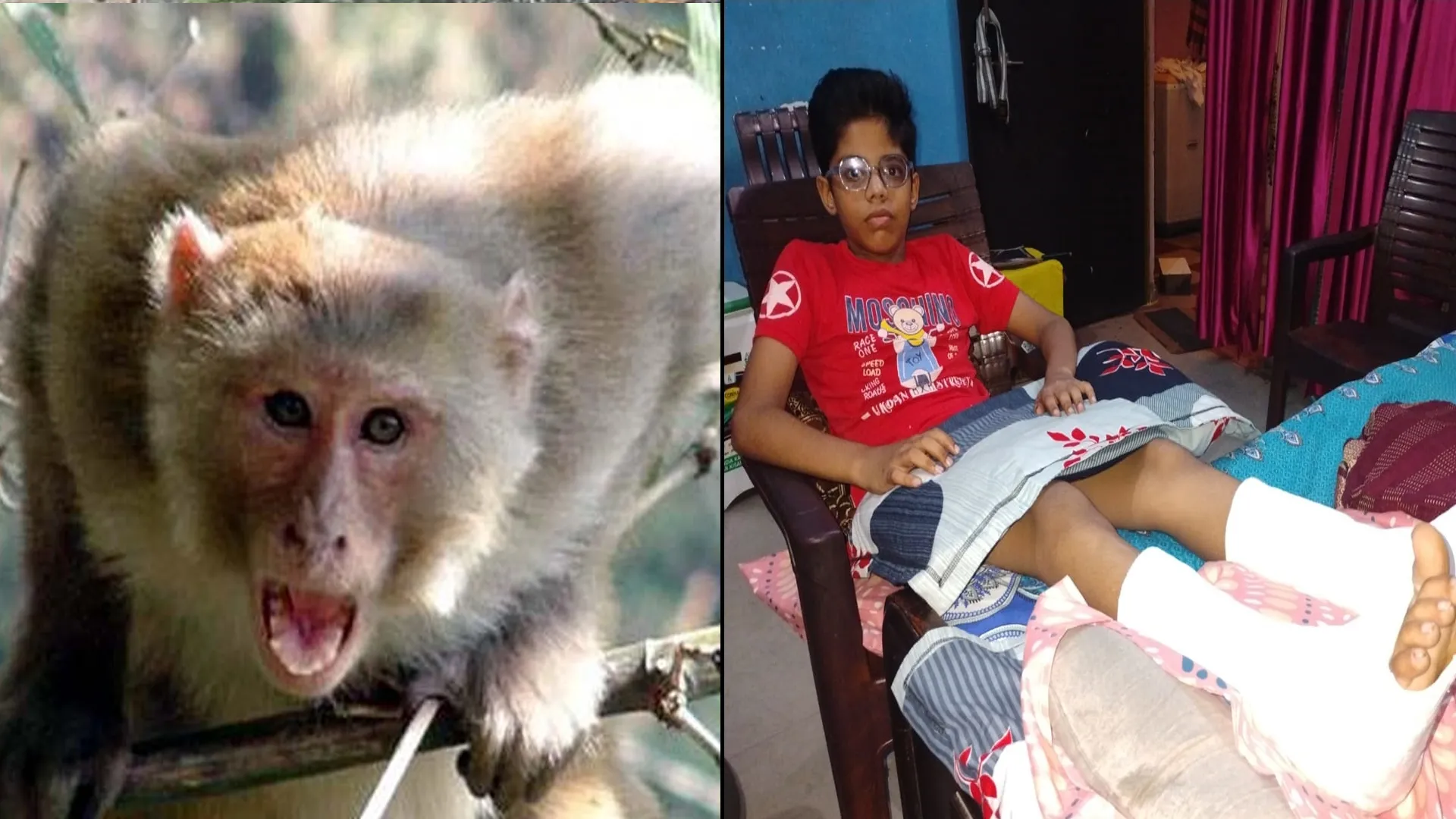 बरेली : बंदरों ने दौड़ाया तो आठवीं के छात्र के छत से गिरकर दोनों पैर टूटे