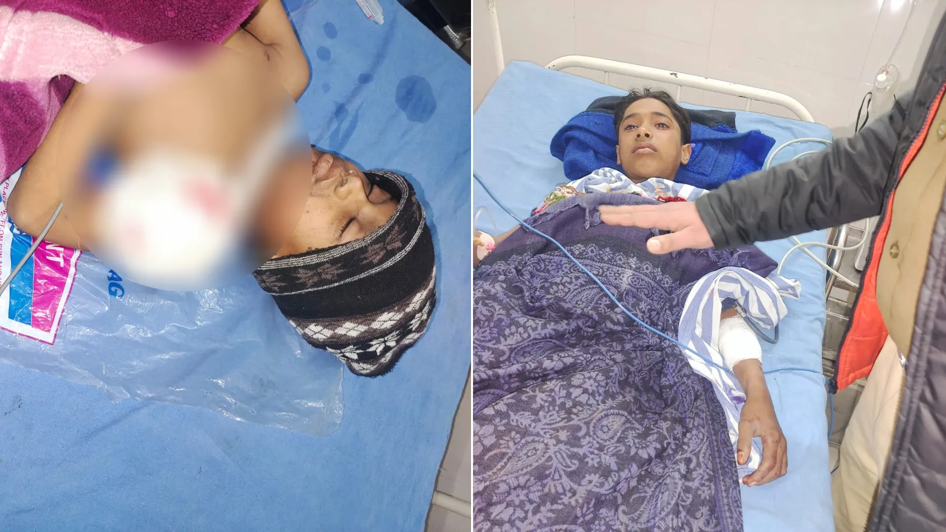 मुरादाबाद: जानवर भगाने को खेत में रखा बम फटा, चपेट में आकर दो बच्चे झुलसे